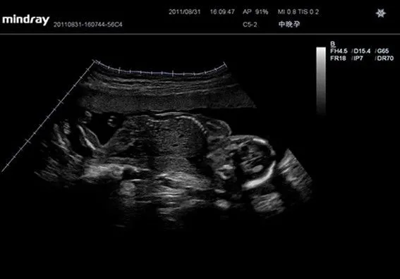 Клинические изображения УЗИ аппарат Mindray DC-T6