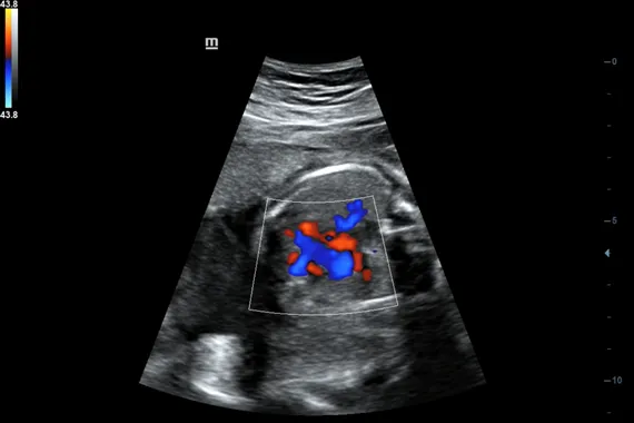 Клинические изображения УЗИ аппарат Mindray DC-45