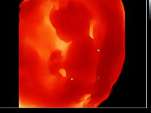 Клинические изображения УЗИ аппарат Mindray DC-70 Exp