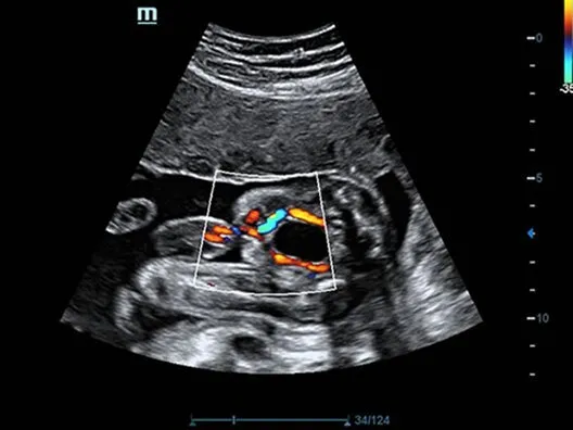 Клинические изображения УЗИ аппарат Mindray DC-70 Exp