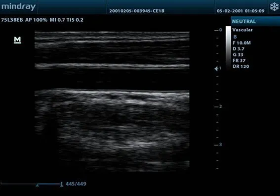 Клинические изображения УЗИ аппарат Mindray M9T портативный
