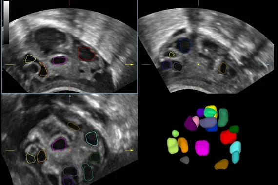 Клинические изображения УЗИ аппарат Mindray DC-45