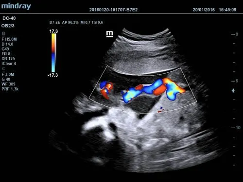 Клинические изображения УЗИ аппарат Mindray DC-40 Exp