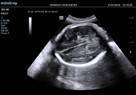 Клинические изображения УЗИ аппарат Mindray DC-40 Exp