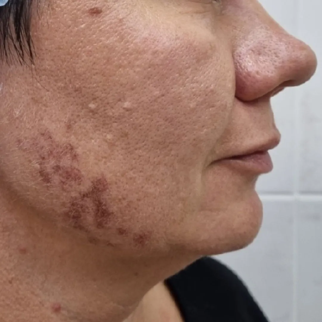 NeoGen омоложение право до.jpg