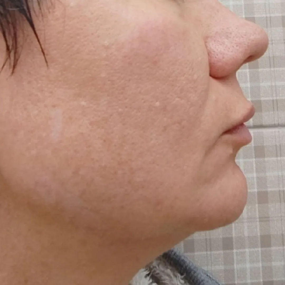 NeoGen омоложение лево после__.jpg