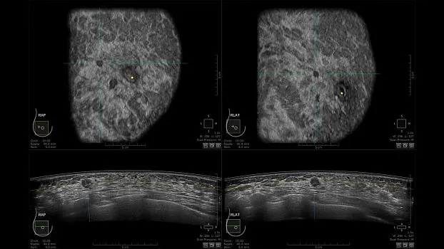 Клинические изображения GE HealthCare Invenia ABUS ультразвуковая система
