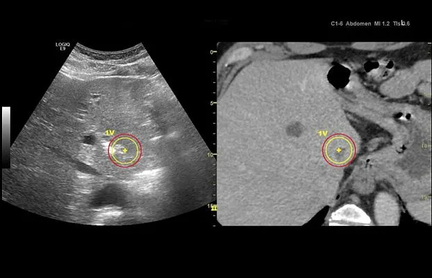 Клинические изображения УЗИ аппарат GE Healthcare Logiq E9 XDclear