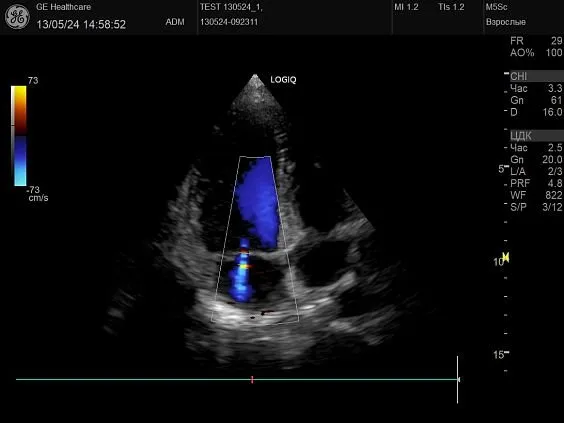 Клинические изображения GE HealthCare Logiq P10 ультразвуковой аппарат