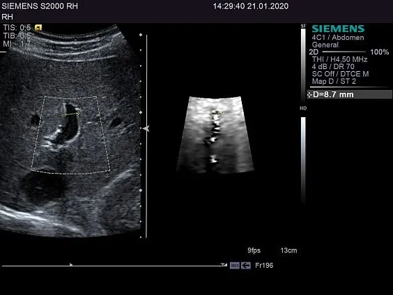 Клинические изображения Siemens ACUSON S2000 ультразвуковая система