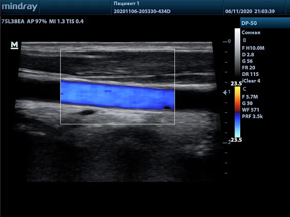 Клинические изображения УЗИ аппарат Mindray DP-50 Color портативный