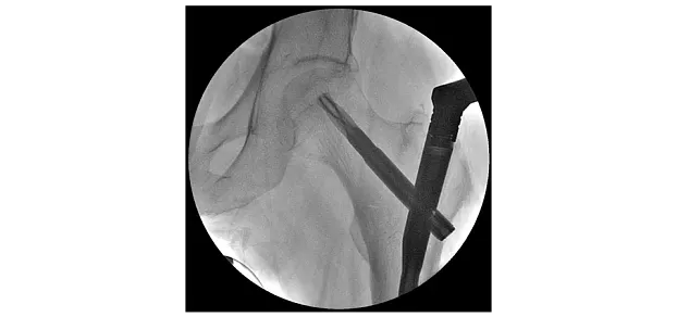 Клинические изображения Philips BV Vectra С-дуга