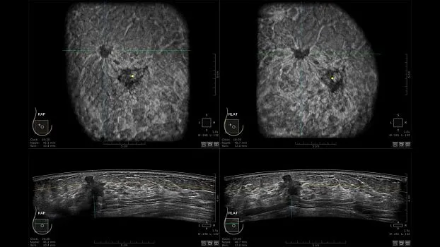 Клинические изображения GE HealthCare Invenia ABUS ультразвуковая система