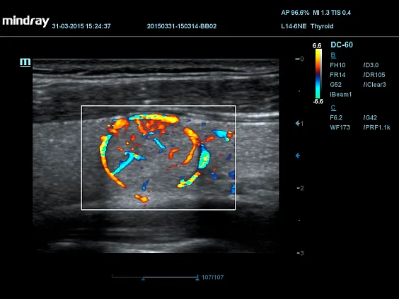 Клинические изображения УЗИ аппарат Mindray DC-60 Exp