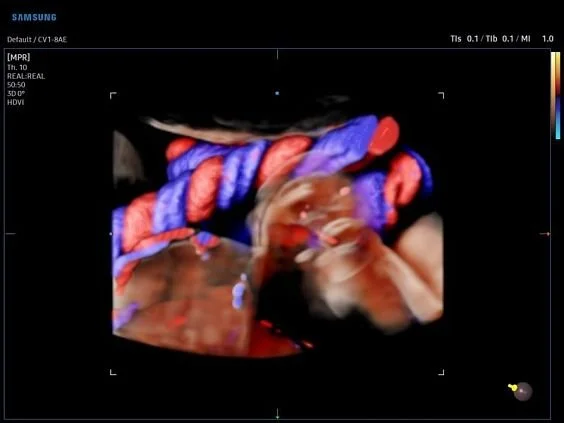 V6-RUS: Пуповина плода, CrystalVue Flow