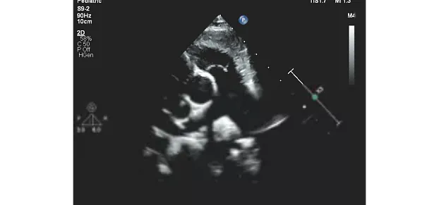 Клинические изображения Philips EPIQ CVx ультразвуковой аппарат