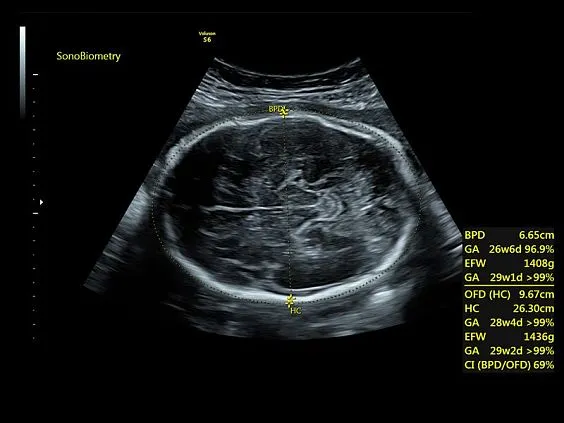 Клинические изображения GE Voluson S6 аппарат УЗИ