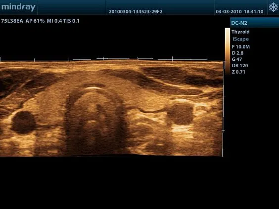 Клинические изображения УЗИ аппарат Mindray DC-N2
