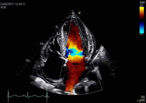 Клинические изображения Ультразвуковая диагностическая система GE HealthCare Vivid E95