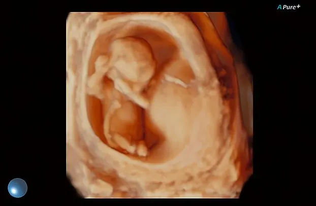 Клинические изображения Canon (Toshiba) Aplio 300 УЗИ аппарат