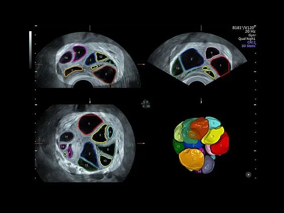 Клинические изображения УЗИ аппарат GE HealthCare Voluson E8 