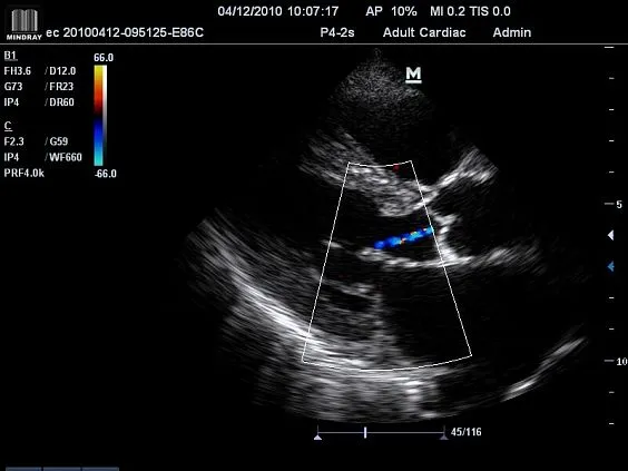 Клинические изображения УЗИ аппарат Mindray M7 портативный