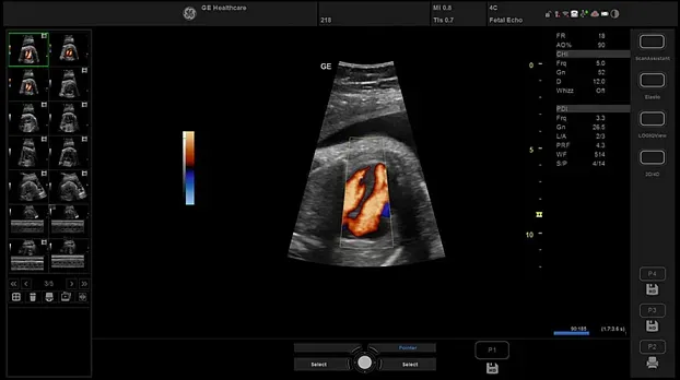 Клинические изображения УЗИ аппарат GE Healthcare Versana Essential 