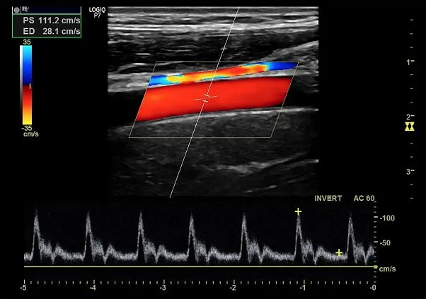 Клинические изображения Logiq P7 УЗИ аппарат GE