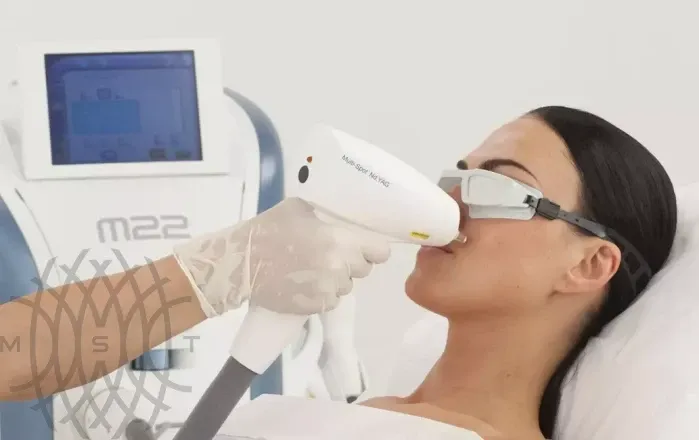 Многопрофильная платформа Lumenis M22 с IPL-насадкой Stellar для фототерапии