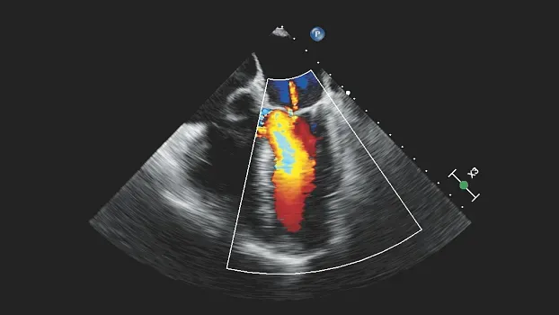 Клинические изображения Philips 5500 ультразвуковой аппарат портативный