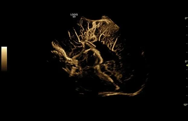 Клинические изображения УЗИ аппарат GE Healthcare Logiq E9 XDclear