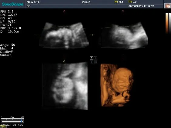 Клинические изображения Sonoscape S8 Exp ультразвуковой аппарат