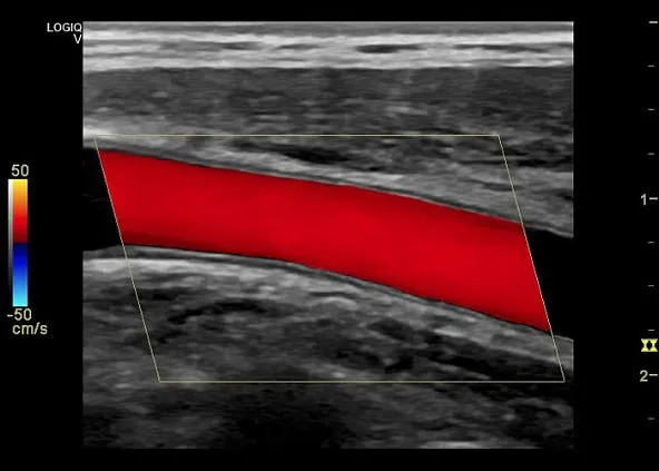 Клинические изображения Ультразвуковая диагностическая система GE Logiq V5