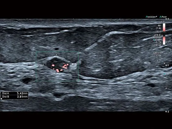 Клинические изображения Canon (Toshiba) Aplio a450 аппарат УЗИ