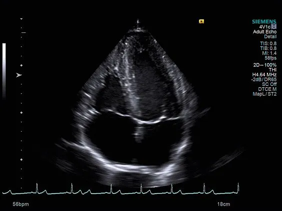Клинические изображения Siemens Acuson S1000 ультразвуковая система