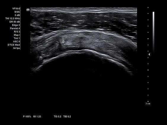 Клинические изображения Ультразвуковая система Siemens Acuson NX3