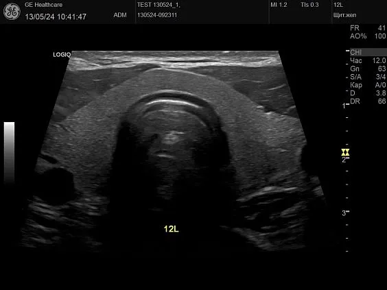 Клинические изображения GE HealthCare Logiq P10 ультразвуковой аппарат