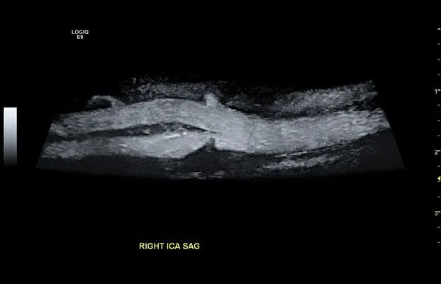 Клинические изображения УЗИ аппарат GE Healthcare Logiq E9 XDclear