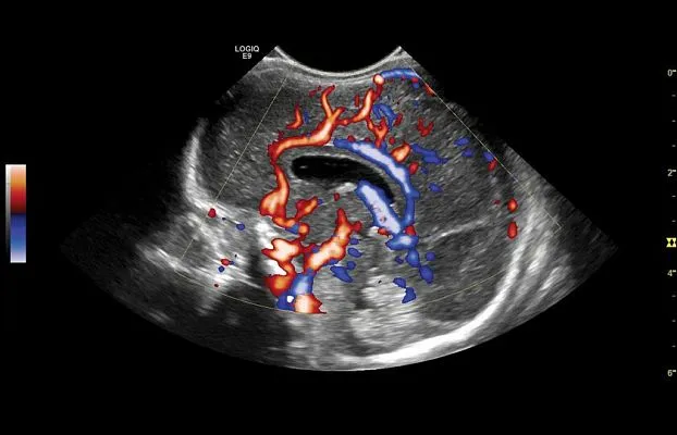 Клинические изображения УЗИ аппарат GE Healthcare Logiq E9 XDclear