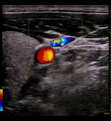 Клинические изображения GE Venue 50 аппарат УЗИ портативный