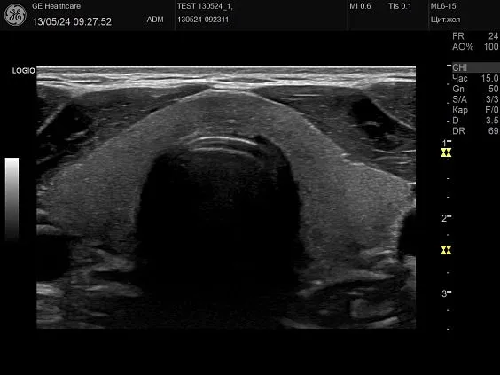 Клинические изображения GE HealthCare Logiq P10 ультразвуковой аппарат
