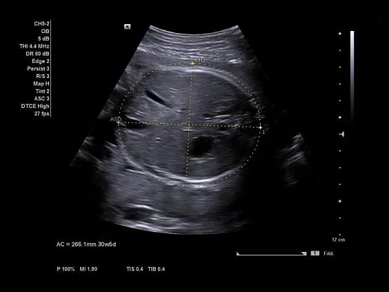 Клинические изображения Ультразвуковая система Siemens Acuson NX3