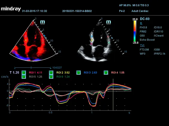 Клинические изображения УЗИ аппарат Mindray DC-60 X-Insight