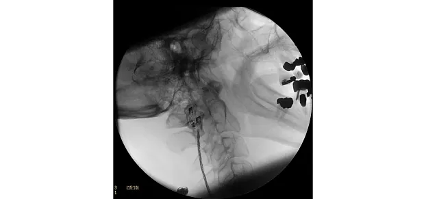 Клинические изображения Philips BV Pulsera С-дуга