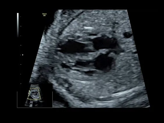 Клинические изображения GE Voluson S8 ультразвуковой аппарат