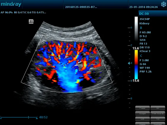 Клинические изображения УЗИ аппарат Mindray DC-30