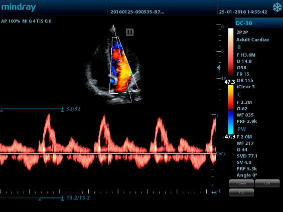 Клинические изображения УЗИ аппарат Mindray DC-30