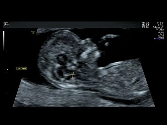 Клинические изображения УЗИ аппарат GE HealthCare Voluson E8 