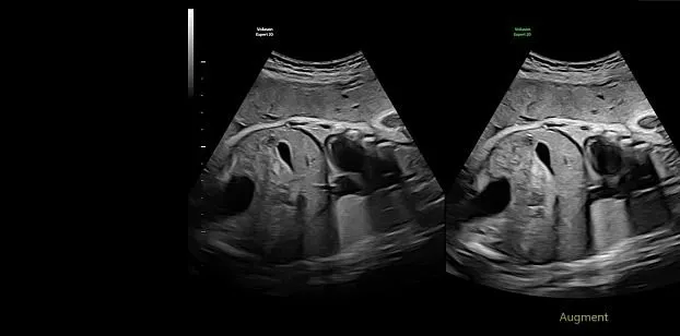 Клинические изображения УЗИ аппарат GE HealthCare Voluson Expert 22