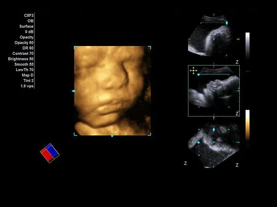 Клинические изображения Ультразвуковая система Siemens Acuson NX3 Elite